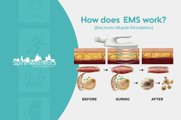 EMS treatment for post pregnancy weight loss treatment Market Drayton