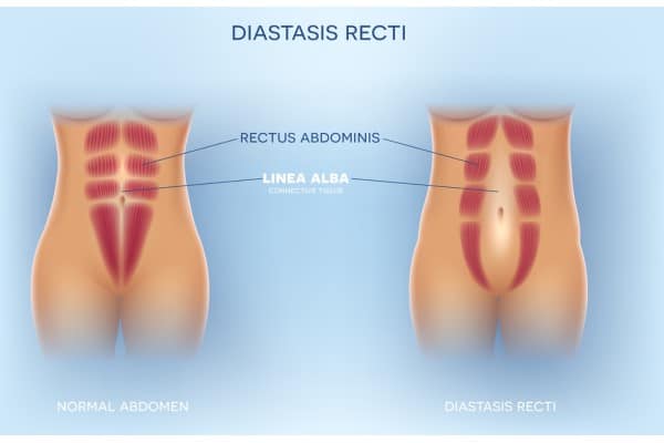 How Does Non-Surgical Treatment Help With Loose Skin, Weak Abdominal Muscles and Post-Pregnancy Changes Market Drayton?