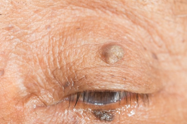 Skin imperfections Market Drayton - Cryopen is fast and effective book in today!