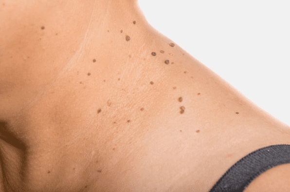 Are you looking for easy skin tag removal Market Drayton - then contact Spire today!