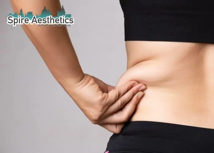Image of woman pinching fat on their hips Market Drayton. Fat Freezing treatment