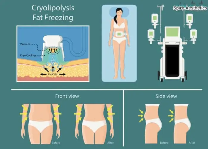 Fat freezing treatment Market Drayton benefits for competitions to remove stubborn fat deposits.