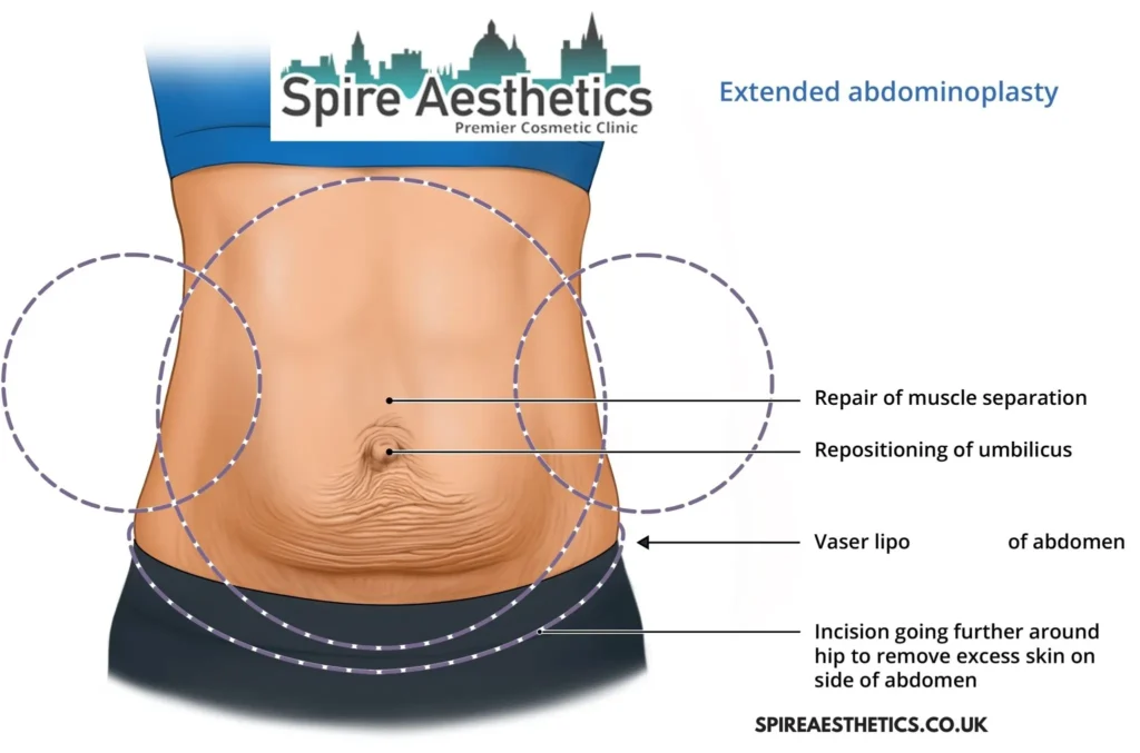 Understanding Loose Skin After Gastric Band Market Drayton Surgery and HIFU Treatment 