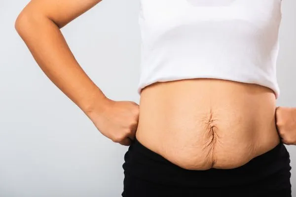 Image of a woman's stomach after weight loss with sagging skin following a gastric band Market Drayton