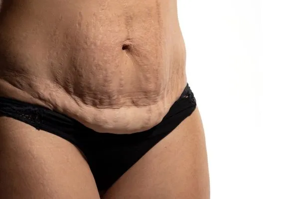 Image of womans stomach after weight loss injections Market Drayton showing saggy skin