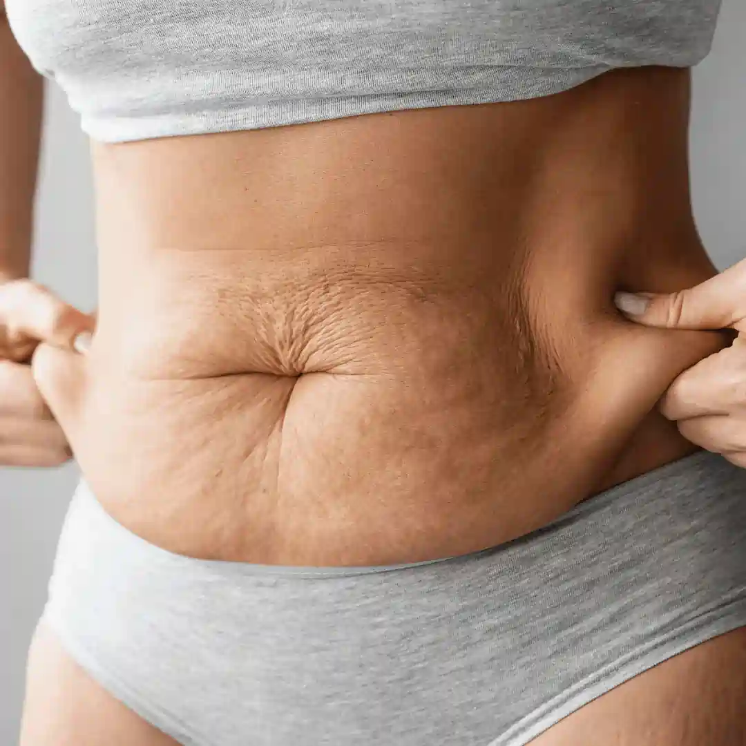 Is It Normal to Have Loose Skin After Pregnancy Market Drayton?