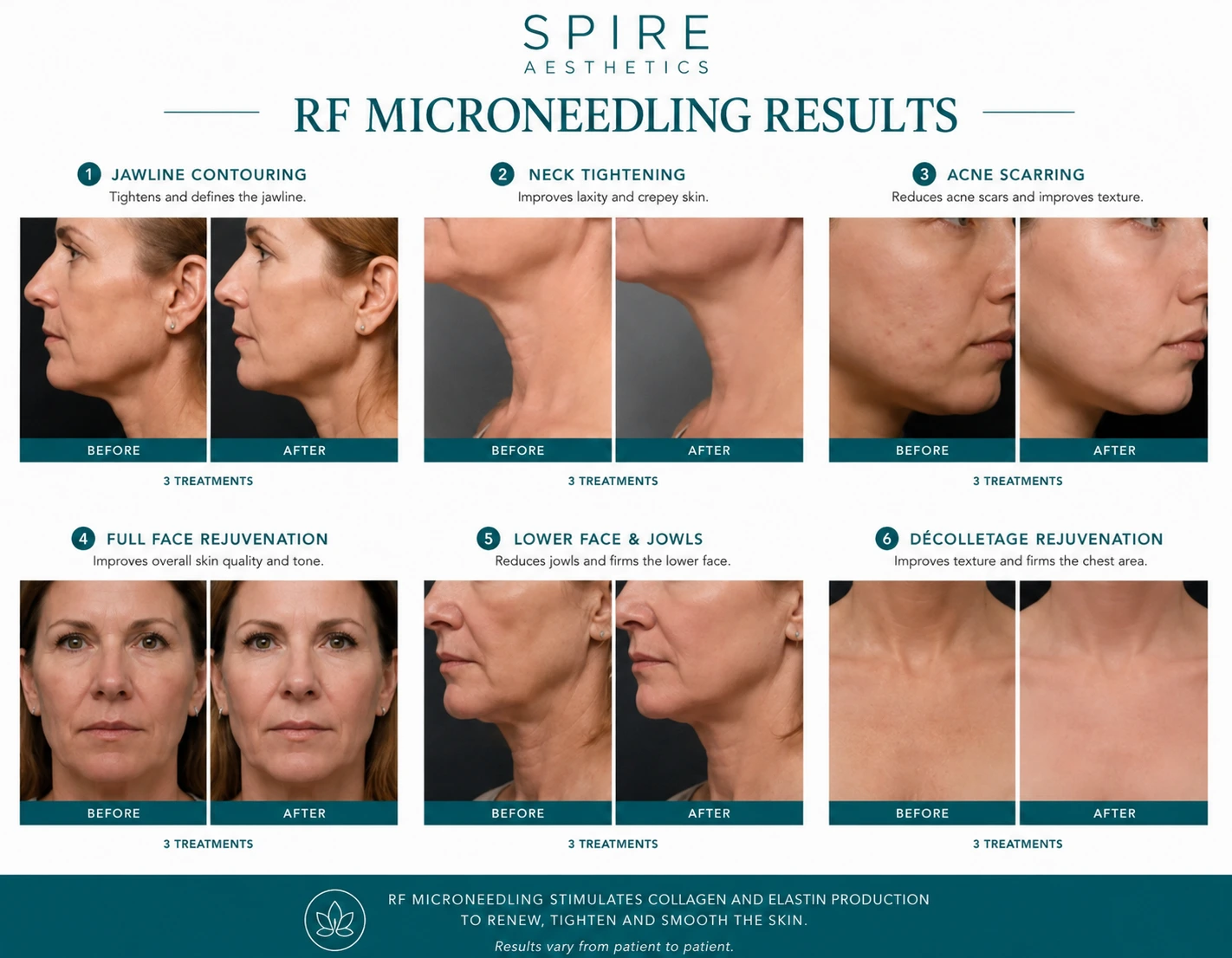 RF Microneedling Skin tightening Market Drayton results
