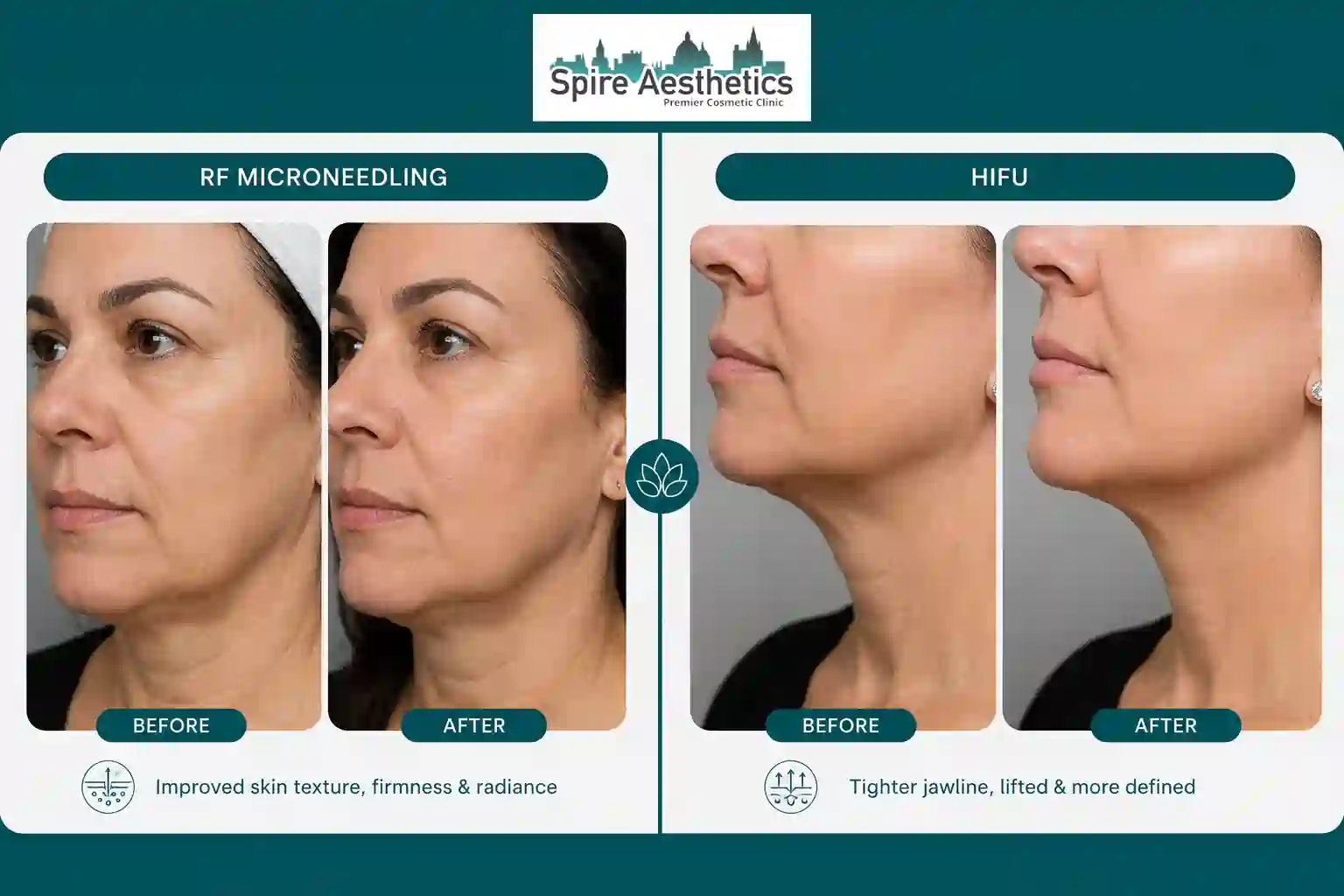Can RF Microneedling and HIFU Be Combined Market Drayton?
