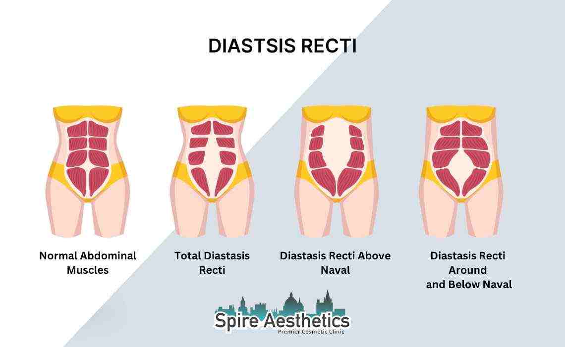 Is Non-Surgical Diastasis Recti Treatment Right for You? Common Concerns Answered Market Drayton
